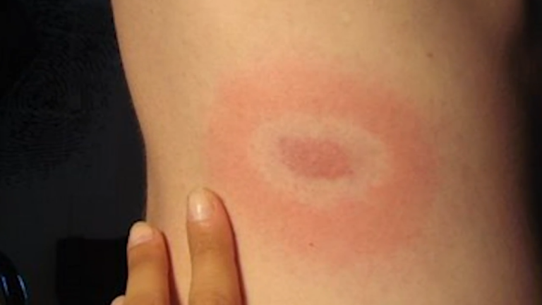 bite mark